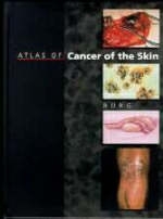 Atlas of Cancer of the Skin - 