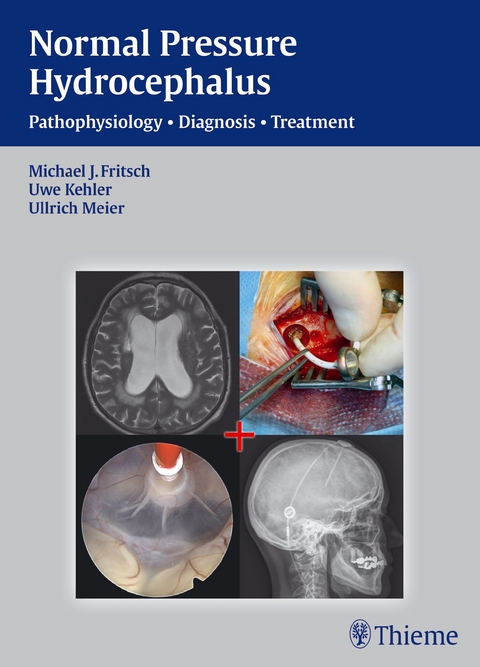 NPH - Normal Pressure Hydrocephalus - Michael J. Fritsch, Uwe Kehler, Ullrich Meier