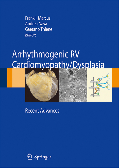 Arrhythmogenic RV Cardiomyopathy/Dysplasia - 