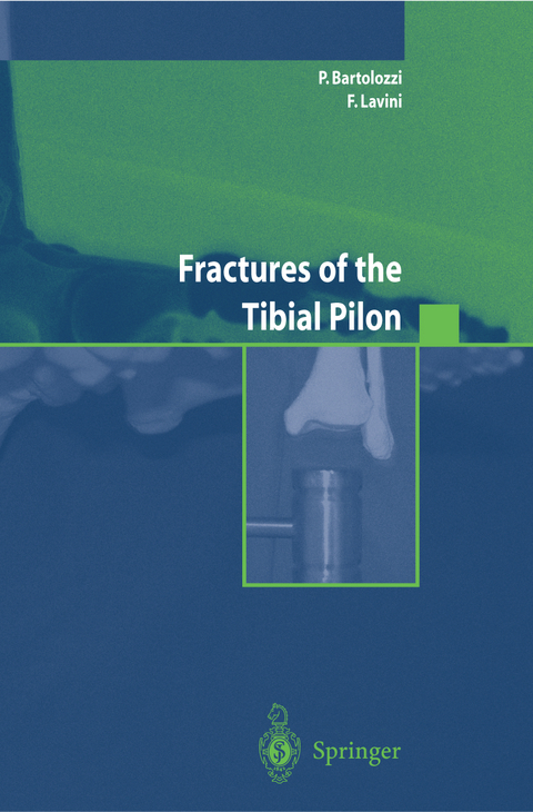 Fractures of the Tibial Pilon - P. Bartolozzi, F. Lavini