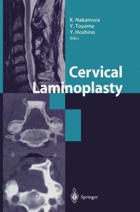 Cervical Laminoplasty - 