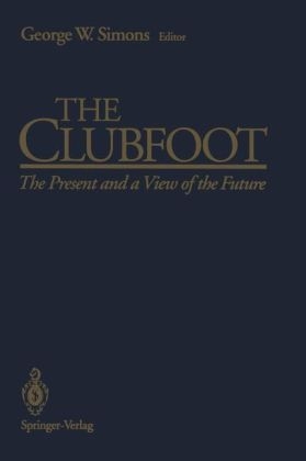 Clubfoot - 