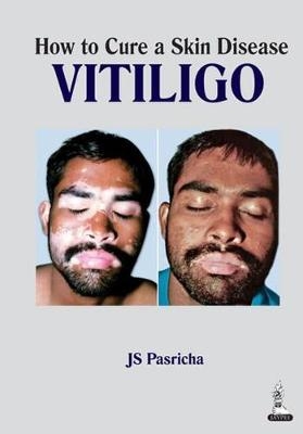 How to Cure a Skin Disease: Vitiligo - JS Pasricha