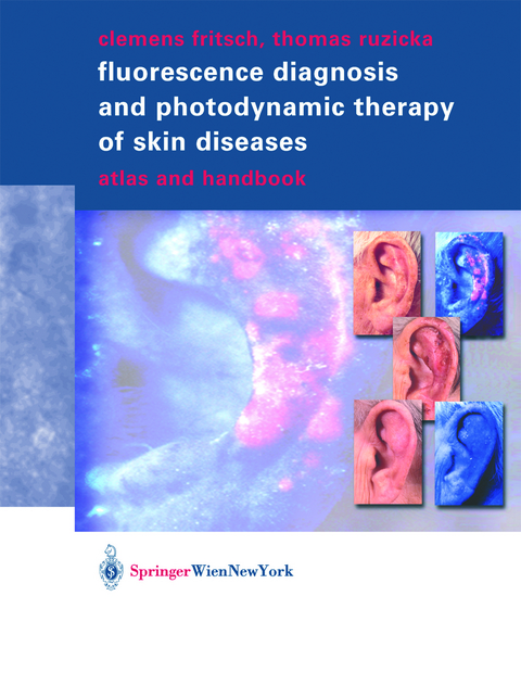 Fluorescence Diagnosis and Photodynamic Therapy of Skin Diseases - Clemens Fritsch, Thomas Ruzicka