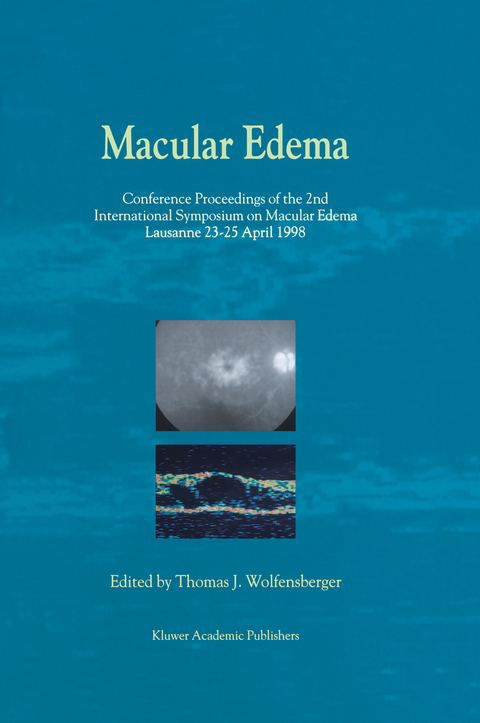 Macular Edema - 