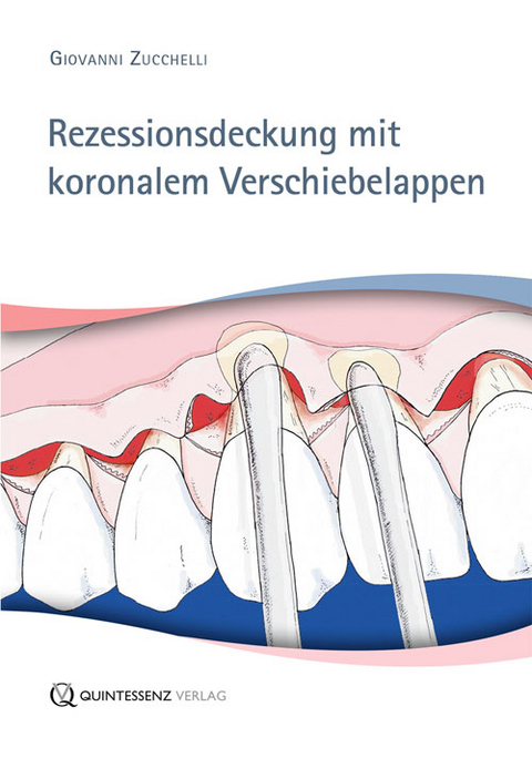 Rezessionsdeckung mit koronalem Verschiebelappen - Giovanni Zucchelli