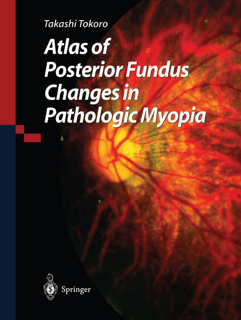 Atlas of Posterior Fundus Changes in Pathologic Myopia - Takashi Tokoro