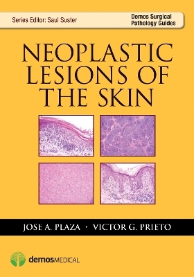 Neoplastic Lesions of the Skin - Jose A. Plaza, Victor G. Prieto