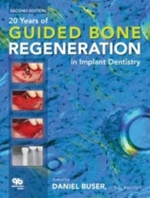 20 Years of Guided Bone Regeneration in Implant Dentistry - Daniel Buser