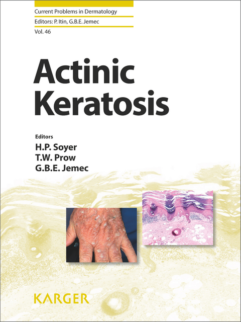 Actinic Keratosis - 