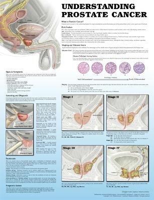 Understanding Prostate Cancer 2e Laminated -  Anatomical Chart Company, James Gulley