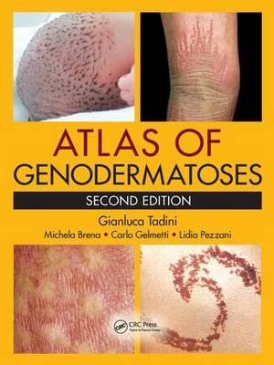 Atlas of Genodermatoses, Second Edition -  Michela Brena,  Carlo Gelmetti,  Lidia Pezzani,  Gianluca Tadini