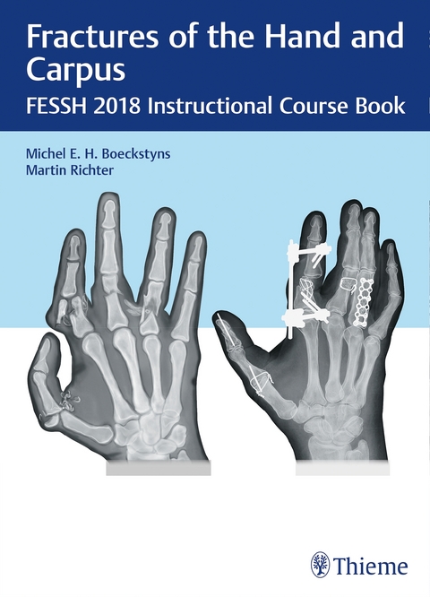 Fractures of the Hand and Carpus - 