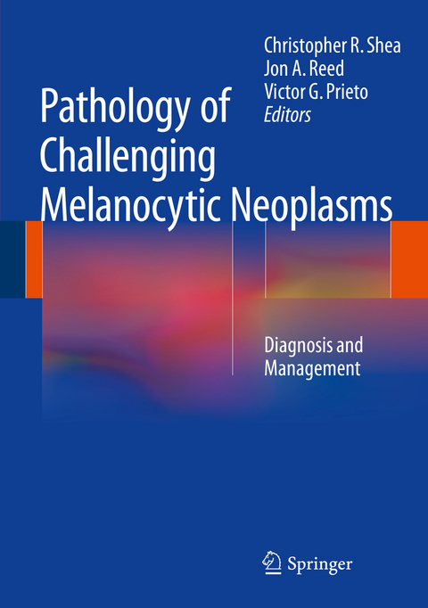 Pathology of Challenging Melanocytic Neoplasms - 