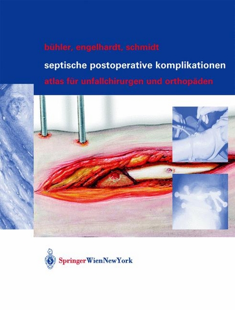 Septische postoperative Komplikationen - Matthias Bühler, Martin Engelhardt, Hergo G.K. Schmidt