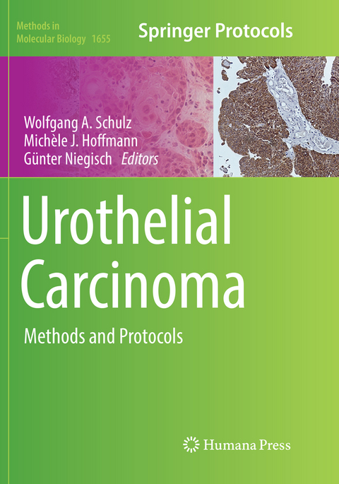 Urothelial Carcinoma - 