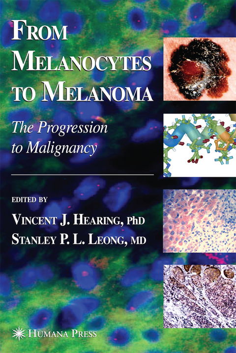 From Melanocytes to Melanoma - 