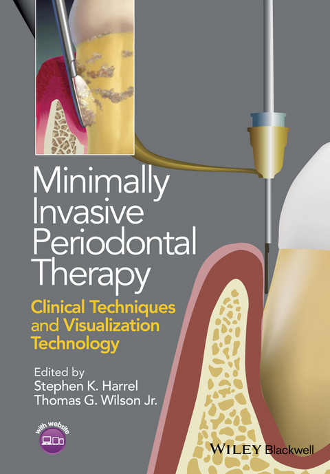 Minimally Invasive Periodontal Therapy - Stephen K. Harrel, Thomas G. Wilson