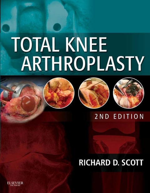 Total Knee Arthroplasty E-Book -  Richard D. Scott