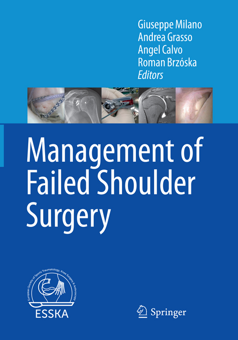 Management of Failed Shoulder Surgery - 