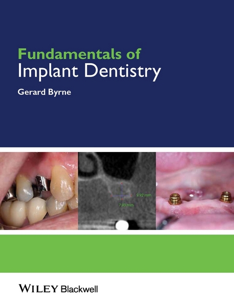 Fundamentals of Implant Dentistry - Gerard Byrne