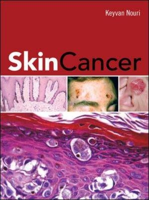 Skin Cancer -  Keyvan Nouri