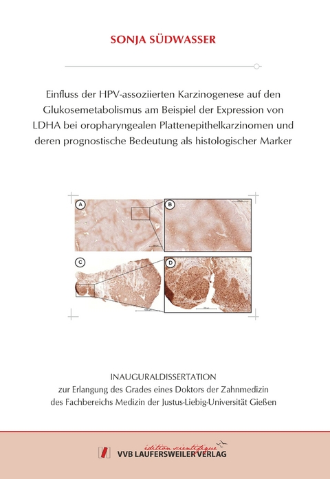 Einfluss der HPV-assoziierten Karzinogenese auf den Glukosemetabolismus am Beispiel der Expression von LDHA bei oropharyngealen Plattenepithelkarzinomen und deren prognostische Bedeutung als histologischer Marker - Sonja Südwasser