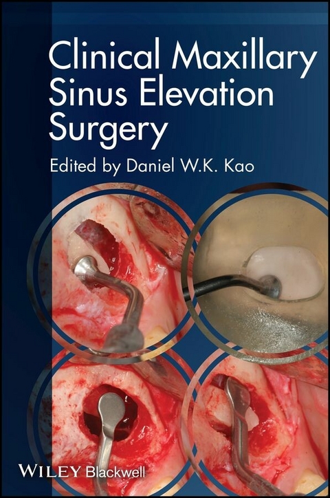 Clinical Maxillary Sinus Elevation Surgery - 