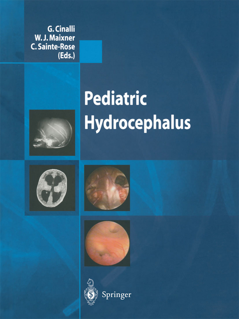 Pediatric Hydrocephalus - 