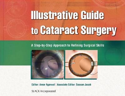 Illustrative Guide to Cataract Surgery - 