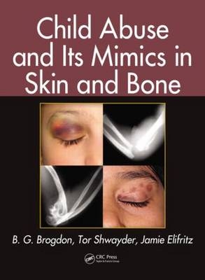 Child Abuse and its Mimics in Skin and Bone -  B. G. Brogdon,  Jamie Elifritz,  Tor Shwayder