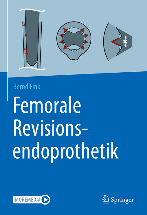 Femorale Revisionsendoprothetik - Bernd Fink