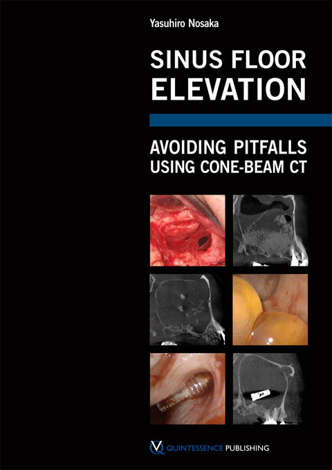 Sinus Floor Elevation - Yasuhiro Nosaka