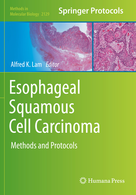 Esophageal Squamous Cell Carcinoma - 