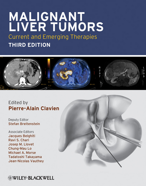 Malignant Liver Tumors - 