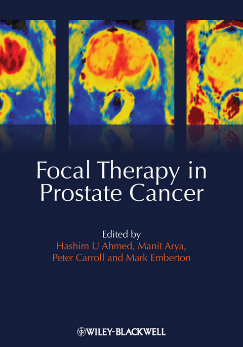 Focal Therapy in Prostate Cancer - 