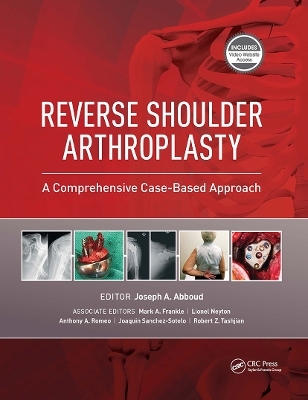 Reverse Shoulder Arthroplasty - Joseph Abboud