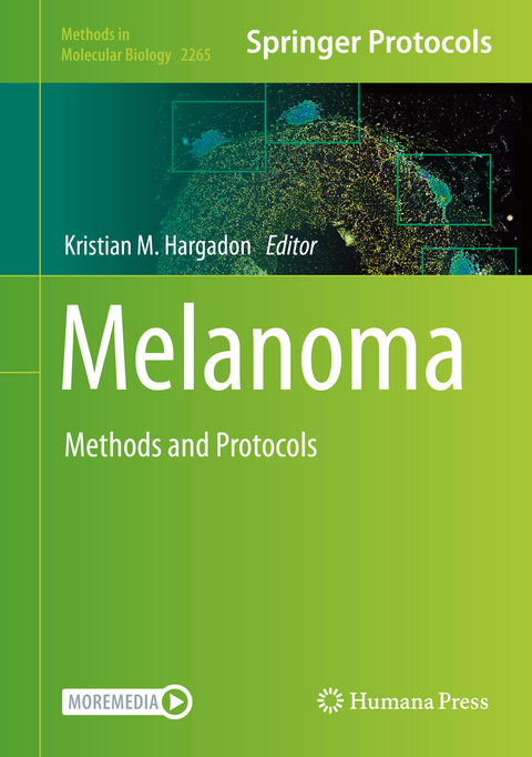 Melanoma - 