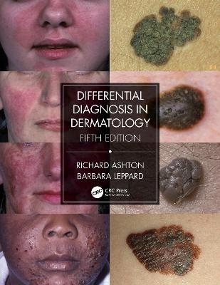 Differential Diagnosis in Dermatology - Richard Ashton, Barbara Leppard