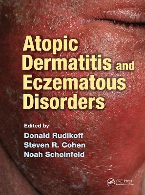 Atopic Dermatitis and Eczematous Disorders - 