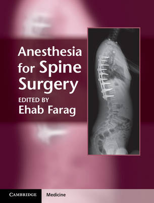 Anesthesia for Spine Surgery - 