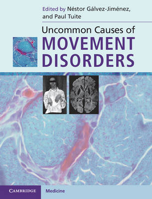 Uncommon Causes of Movement Disorders - 