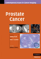 Prostate Cancer - 