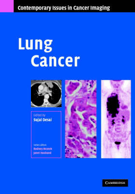 Lung Cancer - 