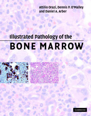 Illustrated Pathology of the Bone Marrow -  Daniel A. Arber,  Dennis P. O'Malley,  Attilio Orazi