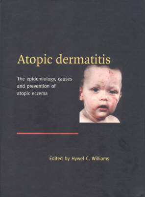 Atopic Dermatitis - 