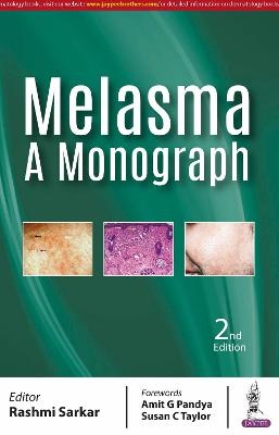 Melasma: A Monograph - Rashmi Sarkar