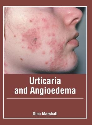 Urticaria and Angioedema - 