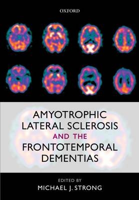 Amyotrophic Lateral Sclerosis and the Frontotemporal Dementias - 