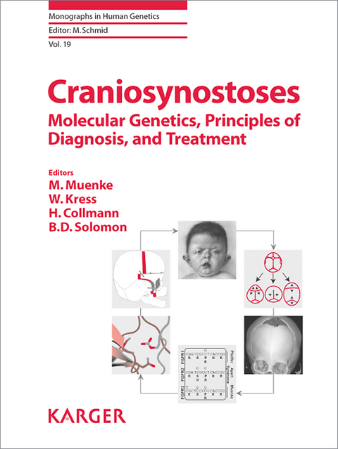 Craniosynostoses - 